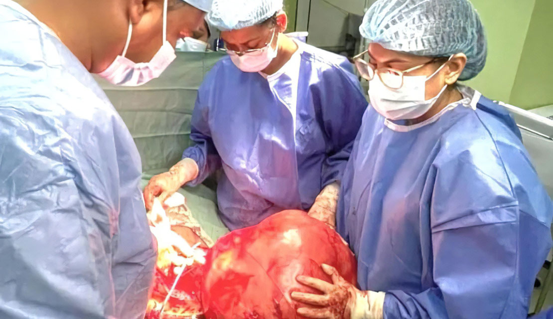 GUYANA | Doctors Remove Massive Intra Abdominal Tumour at Georgetown Public Hospital