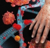 Mpox outbreak in Africa was neglected – it could now turn into the next global pandemic
