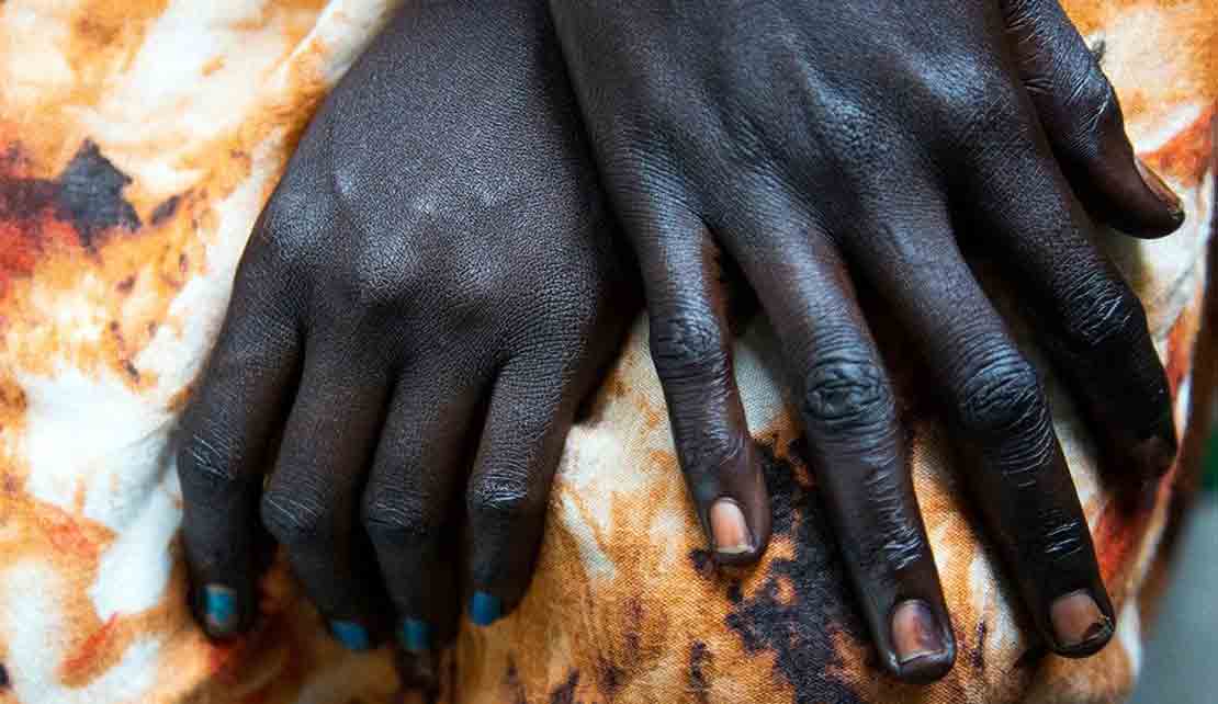 © UNICEF/Albert Gonzalez Farran A South-Sudanese woman who was beaten by her husband seeks refuge in her brother’s house.